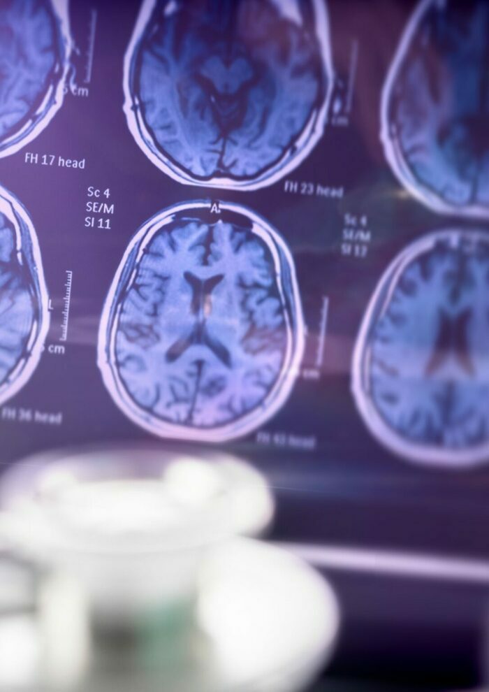 Conférence Alzheimer : est-ce une maladie ?